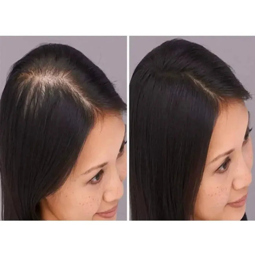 KORMESIC 5% Minoxidil With Biotin Shampoo 300ml