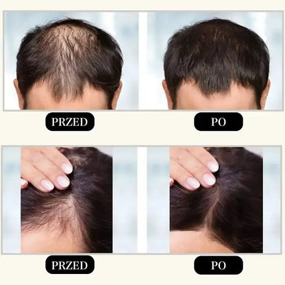 KORMESIC 5% Minoxidil With Biotin Shampoo 300ml
